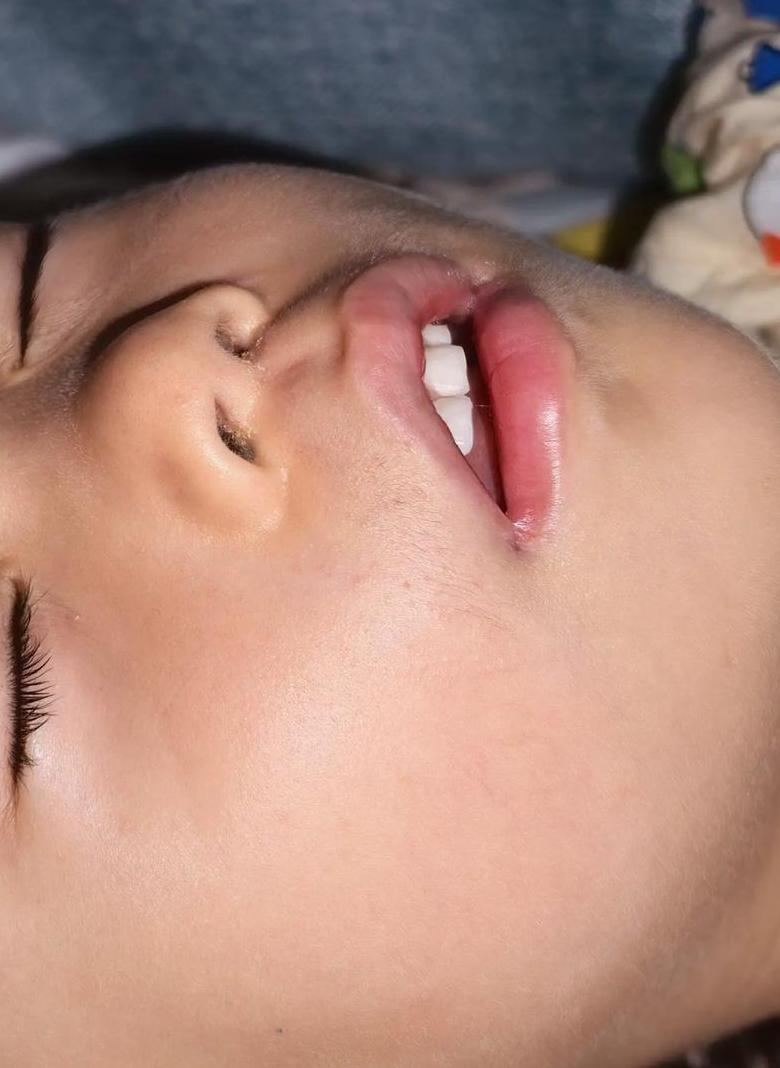 儿童腺样体肥大自愈可能性分析